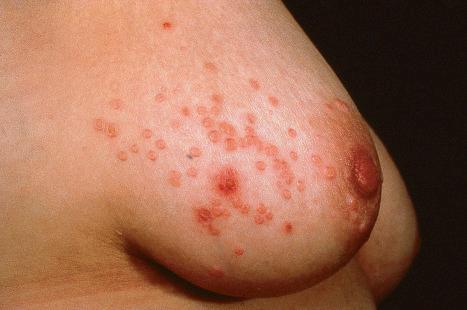 Fig. 18.78, Molluscum contagiosum: this often develops as a result of sexual contact in young adults.