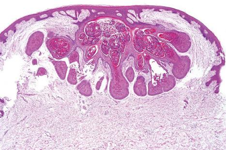 Fig. 18.79, Molluscum contagiosum: characteristic scanning view showing the central umbilication and epidermal hyperplasia.