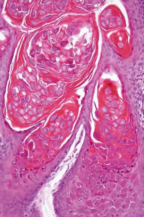 Fig. 18.80, Molluscum contagiosum: the intracytoplasmic inclusions almost completely fill the cell and compress the nucleus.