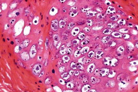 Fig. 18.8, Verruca vulgaris: high-power view of koilocytes.