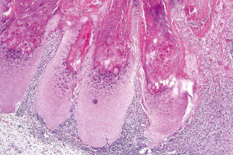 Fig. 18.82, Molluscum contagiosum: rupture of an epidermal nodule has released inclusions into the dermis with a resultant intense chronic inflammatory cell response.