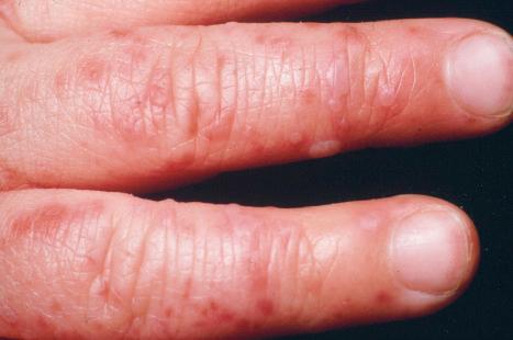 Fig. 18.86, Hand, foot, and mouth disease: note the small vesicles with surrounding erythema.