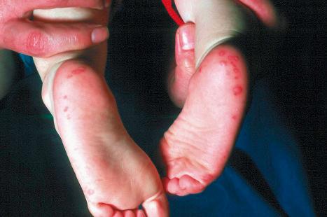 Fig. 18.87, Hand, foot, and mouth disease: there are numerous erosions on the sole of the foot.