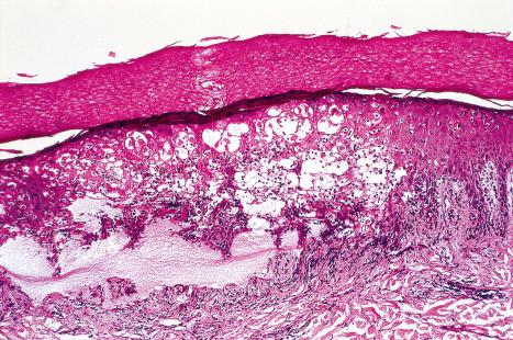 Fig. 18.88, Hand, foot, and mouth disease: this low-power view of the finger shows gross reticular degeneration with intraepidermal vesiculation. Degenerative changes have resulted in separation between the epidermis and the dermis.