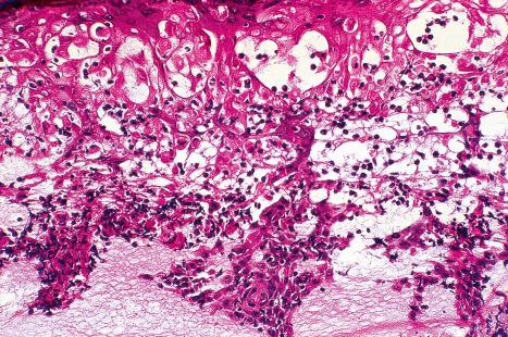 Fig. 18.89, Hand, foot, and mouth disease: the epithelium shows necrosis and dyskeratosis. A chronic inflammatory infiltrate is evident.