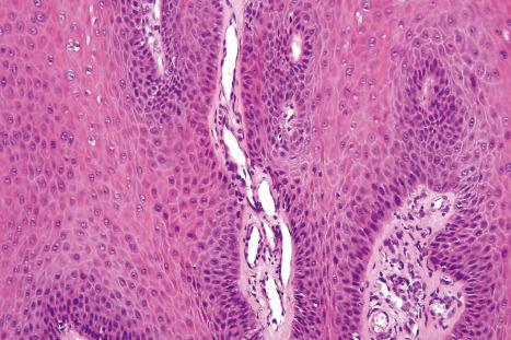 Fig. 18.9, Verruca vulgaris: the core of the papillary projection contains conspicuous dilated capillary loops.