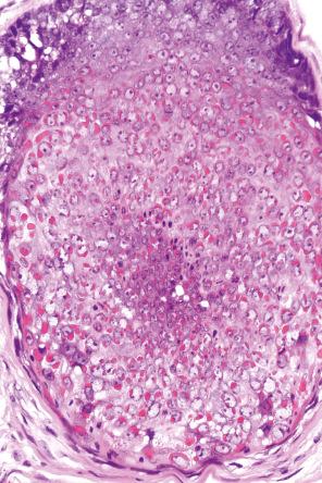 Fig. 18.91, Trichodysplasia spinulosa: note the prominent cytoplasmic granularity and eosinophilia in relation to the hair follicle epithelium.