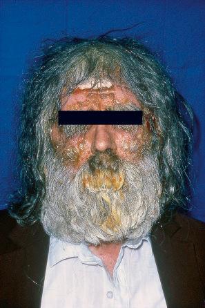 Fig. 18.92, Impetigo: note the crusted lesions on this patient's forehead and cheeks.