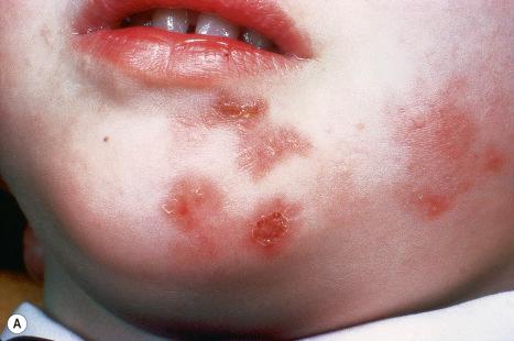 Fig. 18.93, ( A , B ) Impetigo: note that the vesicles are covered by a golden crust. These perioral lesions are at a characteristic site.
