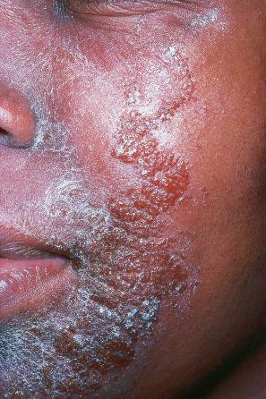 Fig. 18.94, Impetigo: in this patient numerous vesicles are evident.