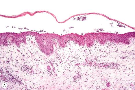 Fig. 18.98, Bullous impetigo: ( A ) the site of cleavage is immediately below the granular cell layer; ( B ) Gram-positive cocci are present.