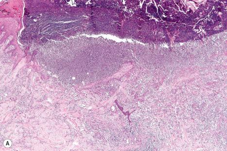 Fig. 18.100, ( A , B ) Ecthyma: there is a sharply delineated ulcer. Artifact is an important differential diagnosis.