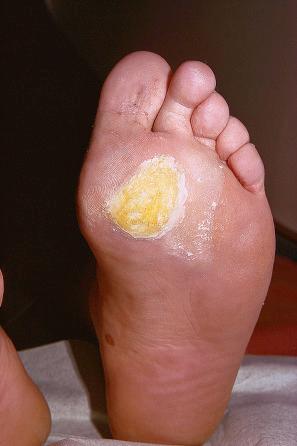 Fig. 18.10, Plantar wart: the lesion is flat and shows very marked hyperkeratosis.