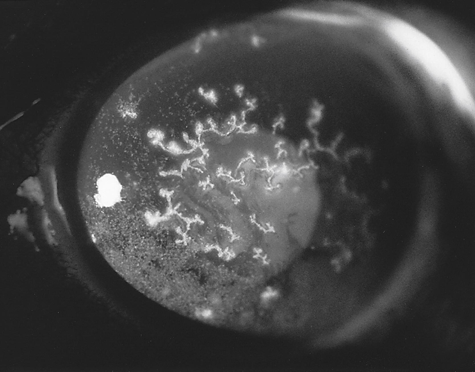 FIGURE 81.1, Classic appearance of primary herpes simplex virus keratitis stained with 1% fluorescein, showing multiple epithelial dendrites.