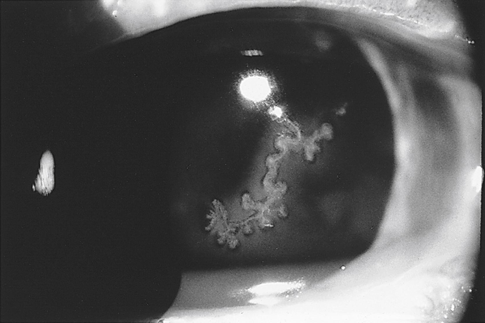 FIGURE 81.2, Slit-lamp appearance of recurrent dendritic keratitis due to herpes simplex virus stained with 1% fluorescein.