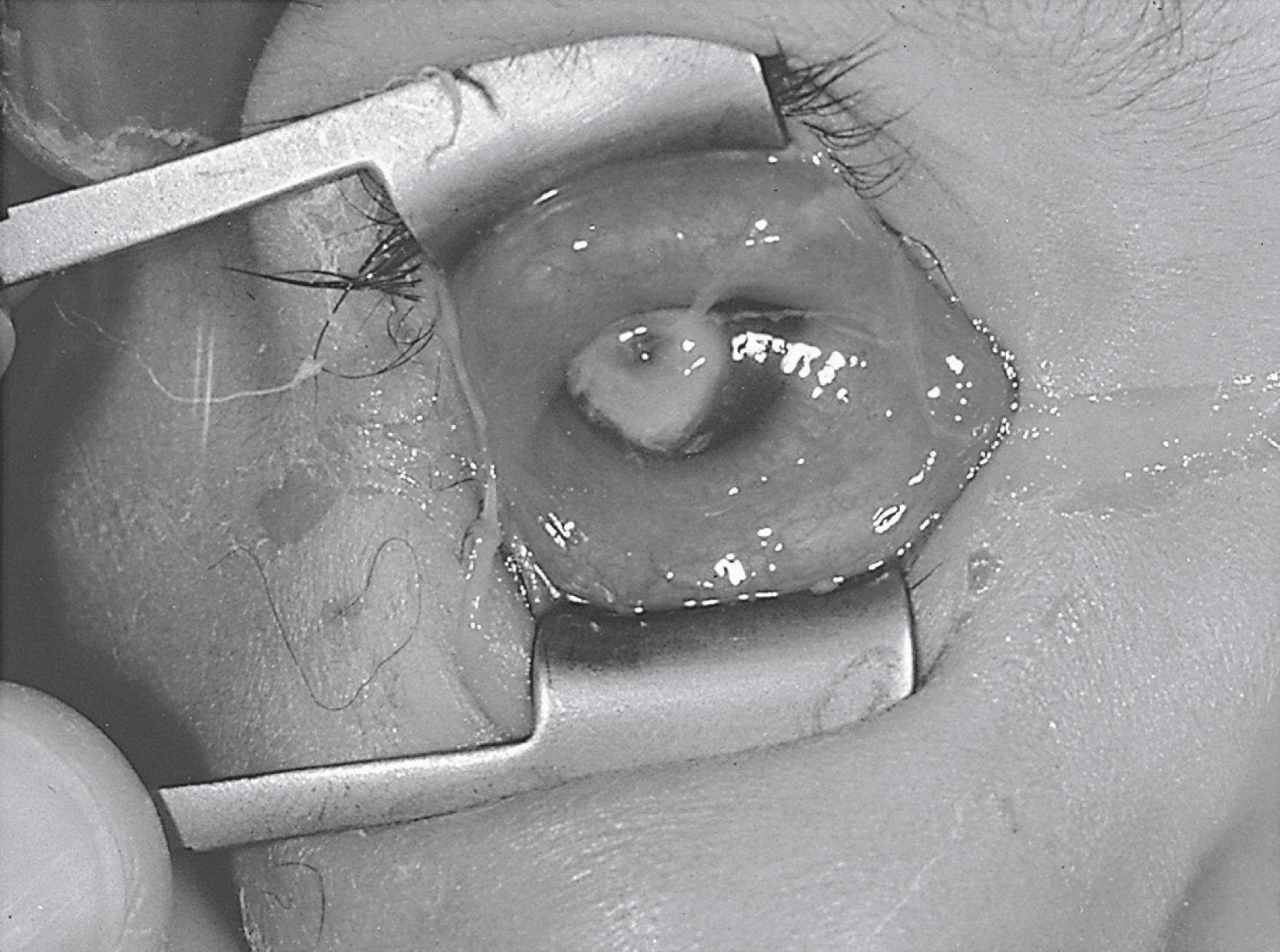 FIGURE 81.4, Perforated keratitis due to Streptococcus pneumoniae in a 3-year-old child after an eye injury.