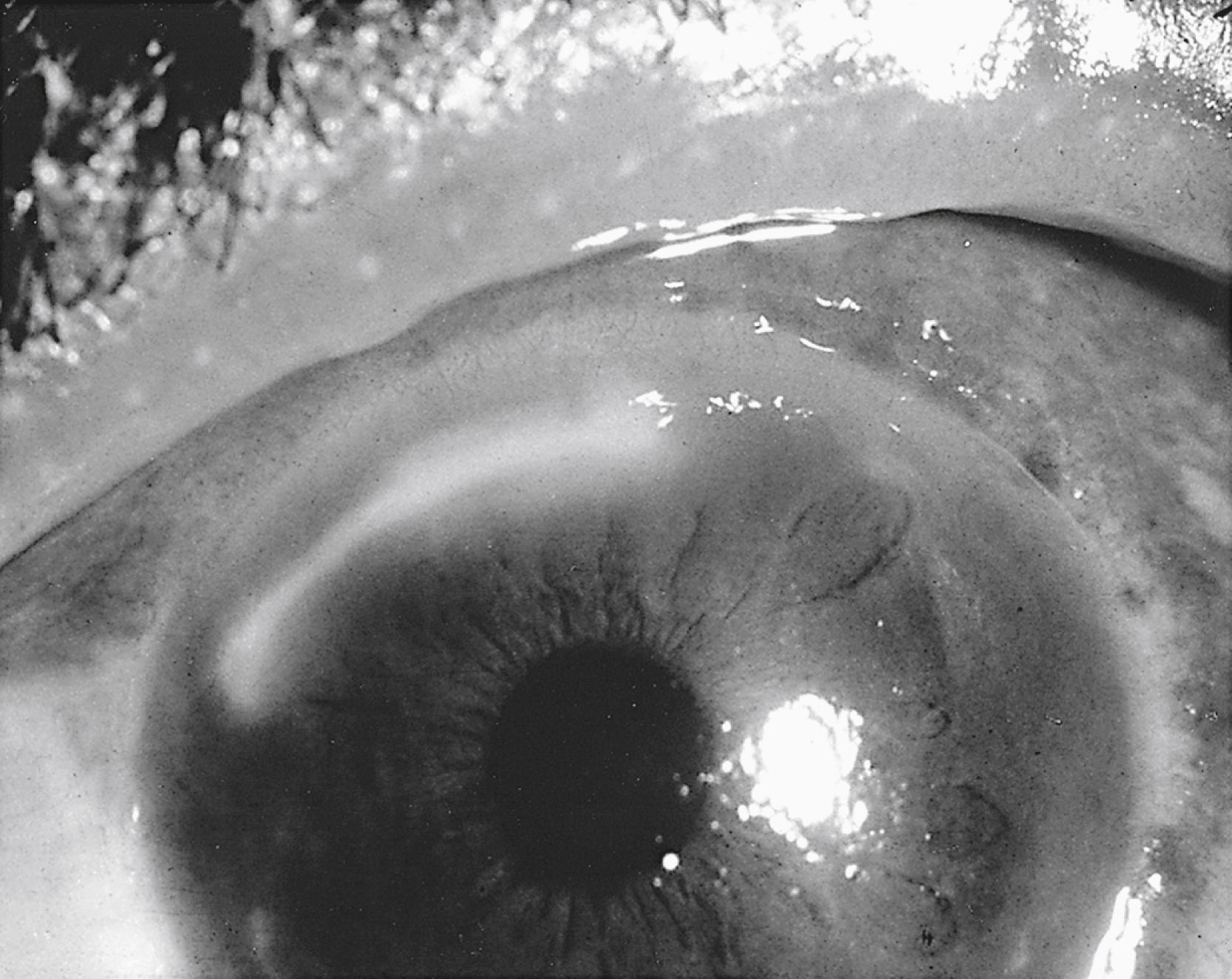 FIGURE 81.5, Extensive marginal keratitis in a child secondary to staphylococcal lid disease. Note the characteristic lucid interval between arcuate infiltrate and corneal limbus.