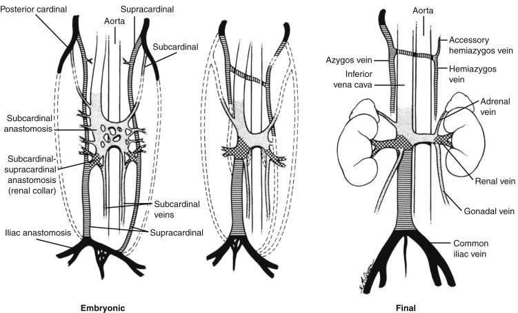 Figure 13-1, Development and normal anatomy of the inferior vena cava (IVC).