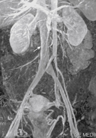 Figure 13-11, Maximum intensity projection of venous phase of gadolinium-enhanced three-dimensional magnetic resonance angiogram showing enhancement of the venous structures ( arrow , IVC).