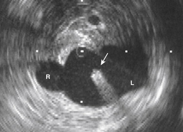 Figure 13-12, Intravenous ultrasound-guided inferior vena cava filter placement. The right (R) and left (L) renal vein origins are well visualized. The apex of the filter (arrow) was placed at this level.