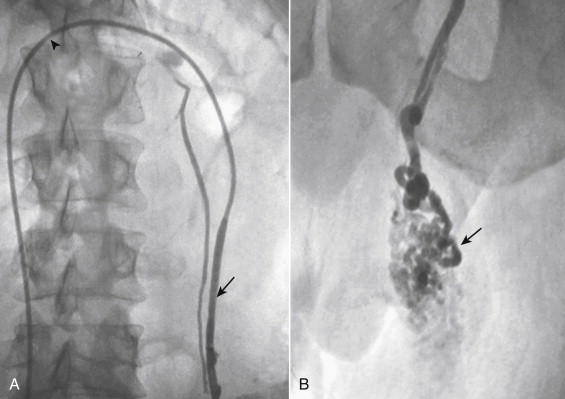 Figure 13-13, Selective left gonadal venogram in a patient with a varicocele. A, The left gonadal vein (arrow) has been selected with a catheter (arrowhead) from the right femoral approach B, Digital image showing a distended pampiniform plexus (arrow).