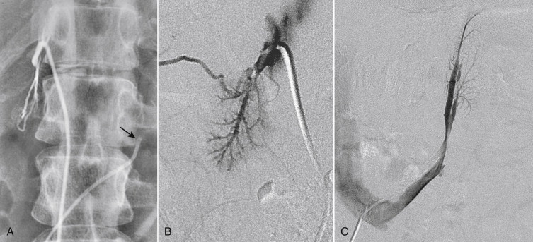 Figure 13-14, Adrenal venography. A, Unsubtracted digital image showing catheterization of both renal veins with injection of contrast on the right. Each catheter has a single side hole (arrow) near the tip to facilitate sampling. B, Digital subtraction image showing a normal right adrenal gland. C, Digital subtraction image showing a normal left adrenal gland.