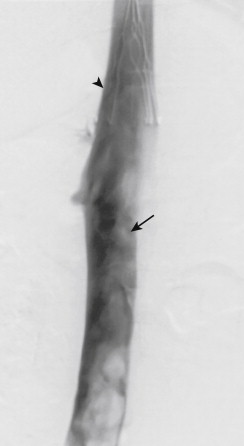 Figure 13-17, Digital subtraction cavogram showing thrombus extending to the level of the renal veins (arrow) . The thrombus is visualized as an intraluminal filling defect outlined by contrast. A vena cava filter (arrowhead) was placed in the suprarenal inferior vena cava.