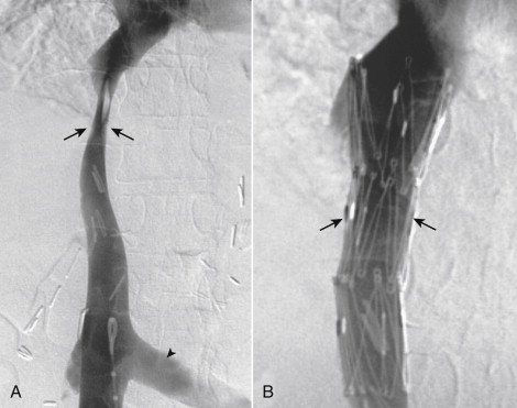 Figure 13-19, Intrahepatic inferior vena cava (IVC) stenosis due to metastatic carcinoid tumor to the liver. The patient had tense bilateral lower extremity edema. A, Digital cavogram showing compression of the intrahepatic IVC (arrows) and reflux into the left renal vein (arrowhead) . There was a 22-mm Hg gradient across the stenosis. B, Digital cavogram after placement of a 20-mm diameter Z-stent (courtesy Cook Group, Bloomington, Ind.) in the intrahepatic IVC (arrows) . The gradient was reduced to 2 mm Hg and the patient’s edema resolved over the next few days.