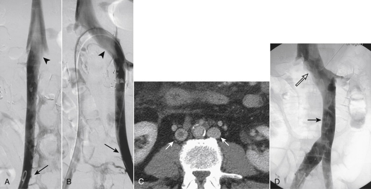 Figure 13-4, Anatomic variants of the inferior vena cava (IVC). A, Digital subtraction cavogram in a patient with a duplicated IVC. The catheter has been inserted from the right femoral vein. There is absent inflow from the left iliac vein (arrow) , the IVC appears smaller than usual, and there is prominent inflow from the left renal vein (arrowhead) . B, The same patient after catheterization of the left IVC (arrow), which empties into the left renal vein (arrowhead) . C, Axial computed tomography scan from a different patient showing typical appearance of a duplicated IVC (arrows) . There is thrombus in the right-sided IVC. D, Left-sided IVC (black arrow) that crosses to the right at the level of the left renal vein (open arrow) .