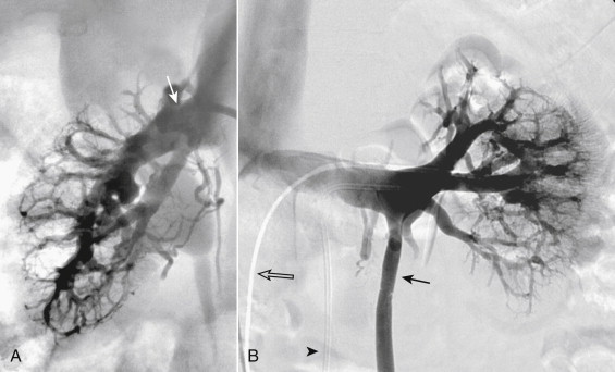Figure 13-5, Normal conventional renal venograms. A, The right renal vein (arrow) is short with a caudal angulation. B, The left renal vein is long, crossing anterior to the aorta and posterior to the superior mesenteric artery to join the inferior vena cava. Note reflux of contrast into the left gonadal vein (arrow) . There is a catheter in the renal artery (arrowhead) , through which 10 μmg of epinephrine was injected to temporarily decrease arterial flow just before injection through the venous catheter (open arrow) .