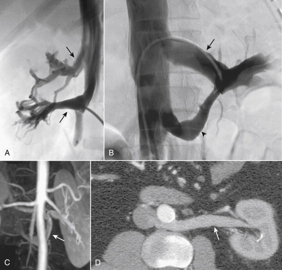 Figure 13-6, Anatomic variants of the renal veins. A, Conventional venogram showing multiple right renal veins (arrows) . B, Digital subtraction study showing a circumaortic left renal vein with preaortic superior (arrow) and retroaortic inferior (arrowhead) components. C, Coronal maximum intensity projection of a contrast-enhanced magnetic resonance angiogram showing a retroaortic left renal vein (arrow) that courses caudad and posterior to the aorta before joining the inferior vena cava. D, Oblique reformatted computed tomography image showing the anatomic relationships of a retroaortic left renal vein (arrow) .