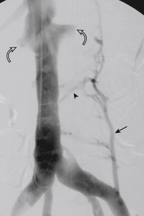 Figure 13-7, Digital subtraction cavogram performed from a jugular vein approach. The left ascending lumbar vein (arrow) communicates with a lumbar vein (arrowhead) . There is reflux into the orifices of both renal veins (curved arrows) .