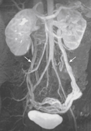 Figure 13-8, Maximum intensity projection of a gadolinium-enhanced three-dimensional magnetic resonance angiogram of a woman showing dilated ovarian veins (arrows) . The direction of flow is retrograde in the left ovarian vein, across the pelvis through the uterine plexus, and antegrade in the right ovarian vein. This patient presented with chronic pelvic pain (see Pelvic Congestion Syndrome).