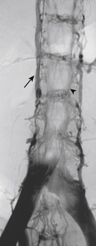 Figure 13-9, Digital subtraction cavogram of a patient with extrinsic compression of the inferior vena cava. There is filling of the para vertebral (arrow) and intravertebral (arrowhead) veins.