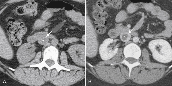 Figure 13-10, Computed tomography scan showing partially calcified subacute thrombus in the inferior vena cava (IVC). A, Noncontrast scan showing calcification in the IVC (arrow) at the level of the duodenum. B, Delayed contrast-enhanced image from the same patient showing the full extent of the thrombus (arrow) .