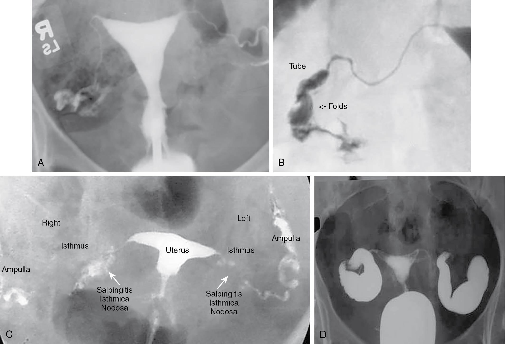 Fig. 40.6, Representative hysterosalpingograms showing (A) a normal study, (B) normal ampullary folds, (C) bilateral salpingitis isthmica nodosa (proximal disease), and (D) bilateral hydrosalpinges (distal disease).