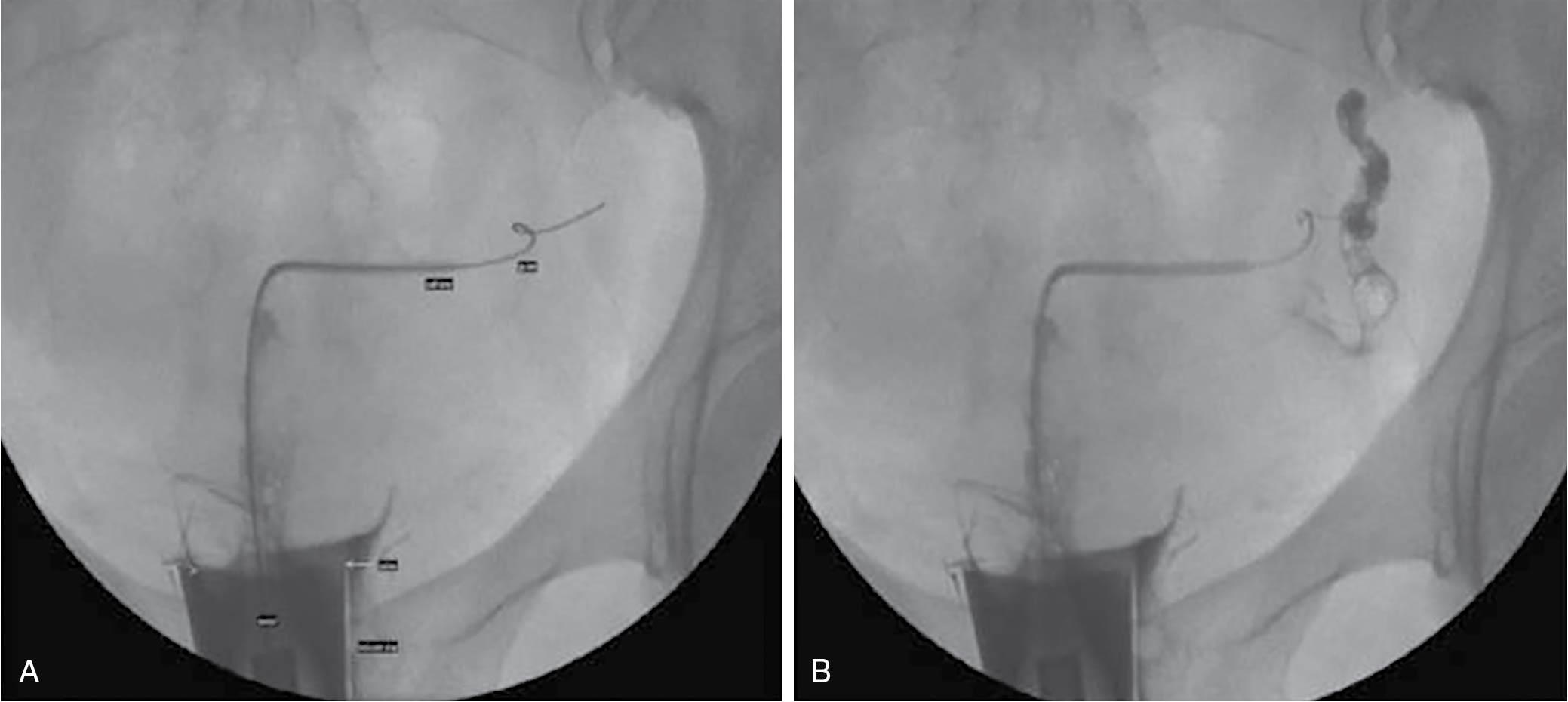 Fig. 40.7, Technique of tubal cannulation using a vacuum cup on the cervix. A, Introduction of a 5.5-French catheter into the tubal ostium under fluoroscopy, by a 0.015-inch guidewire into the fallopian tube for dislodgement of debris. B, Injection of contrast through a 3-French catheter into the tube confirming successful cannulation and a normal-appearing patent tube.