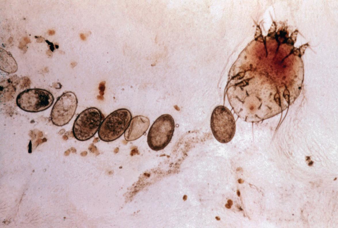 Fig. 84.1, Female scabies mite with eggs and scybala in skin scrapings.