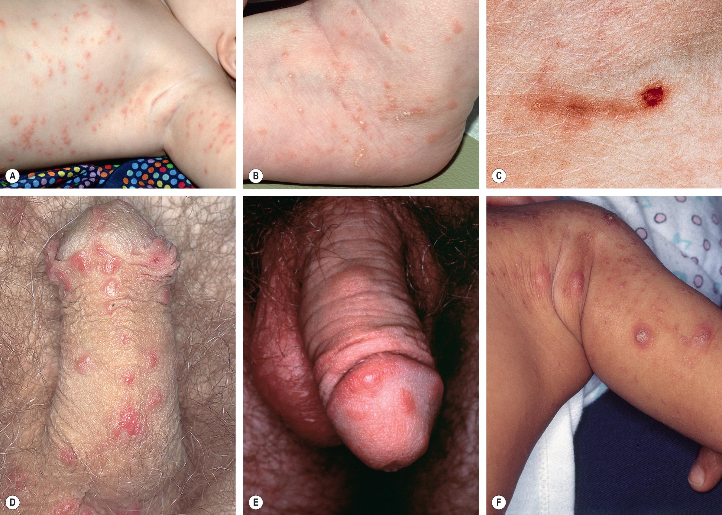 Fig. 84.3, Scabies.