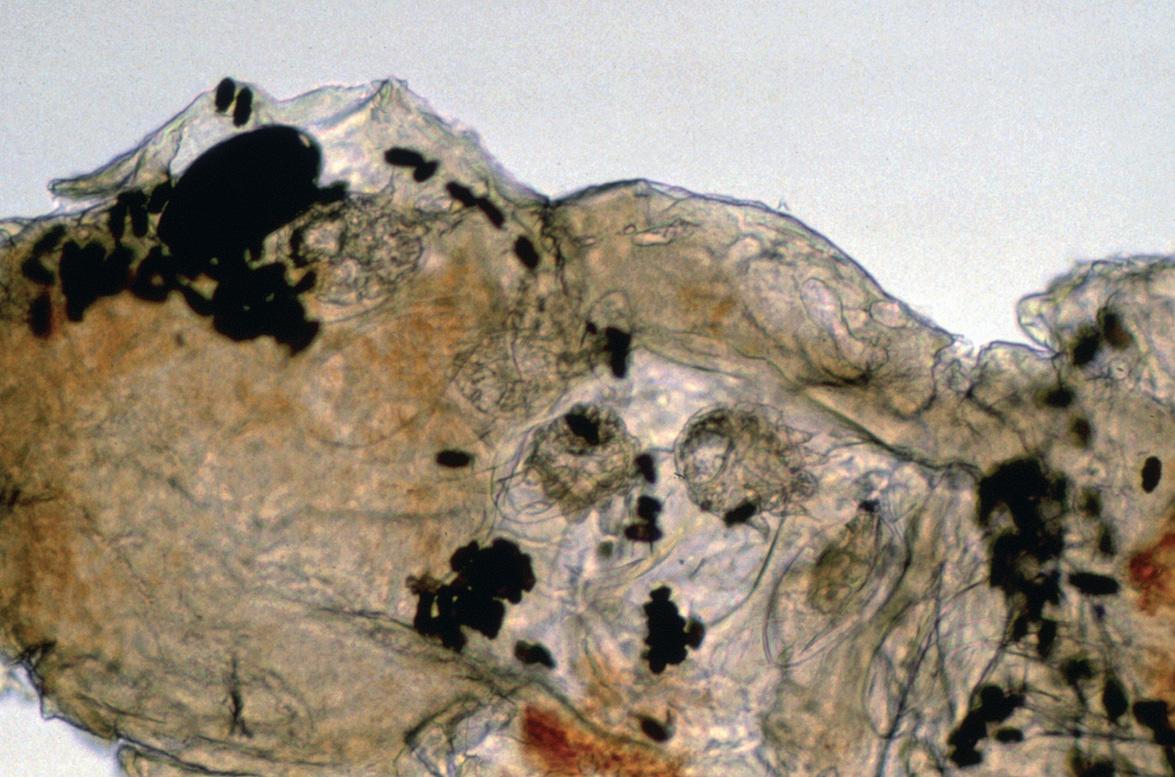 Fig. 84.5, Microscopy of a skin scraping from a patient with scabies.