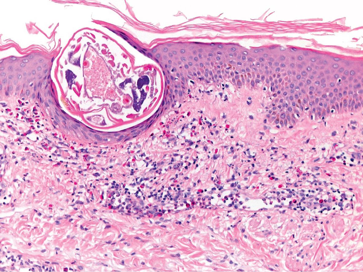 Fig. 84.6, Scabies – histologic features.