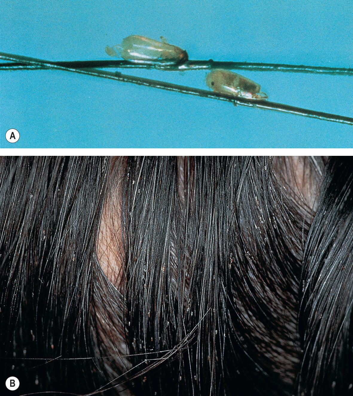 Fig. 84.9, Head lice.