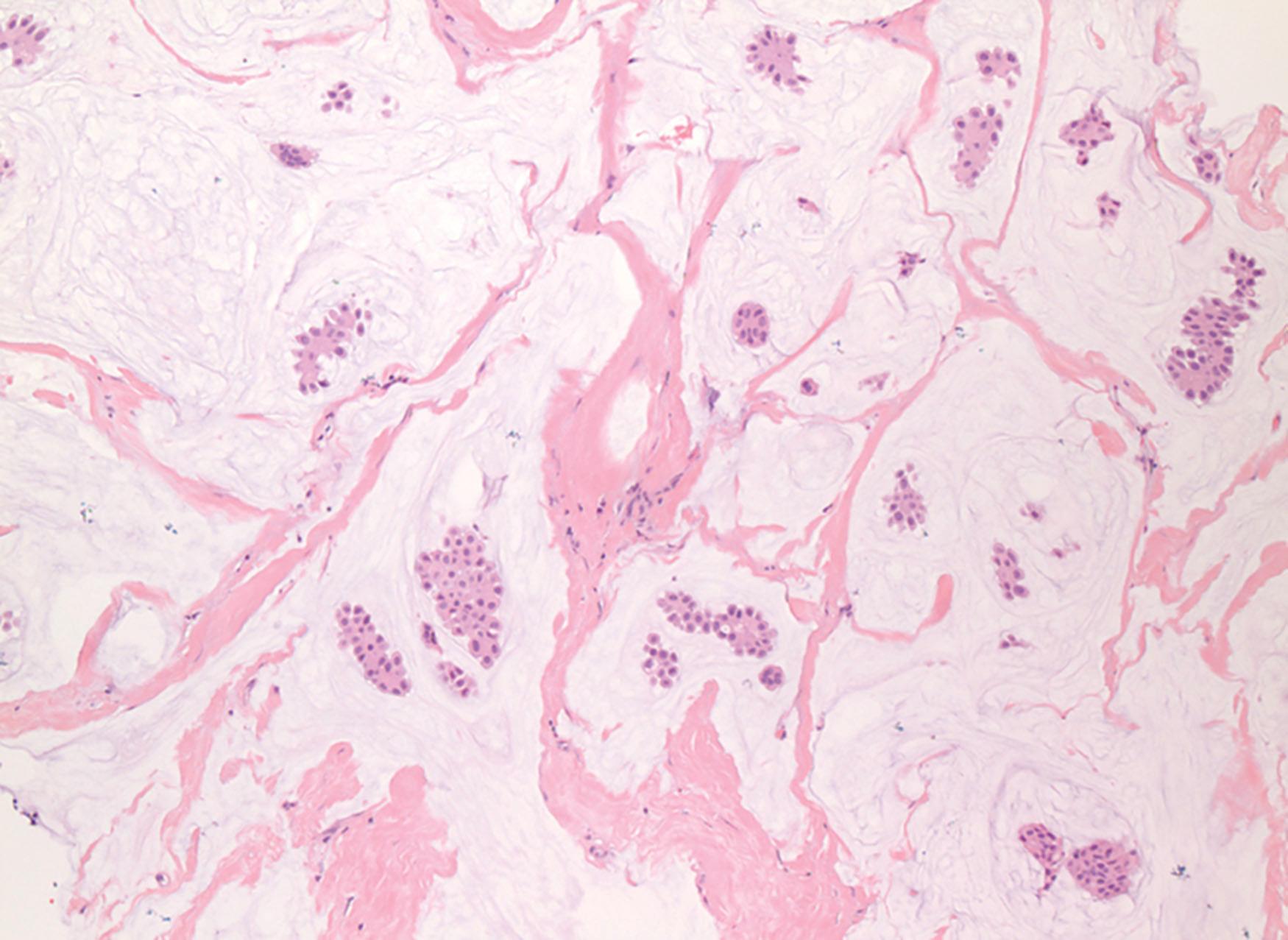 Fig. 20.11, Invasive mucinous carcinoma (Luminal A). MCs show pools of extracellular mucin with clusters of neoplastic cells (hypocellular variant). The neoplastic cells are small to intermediate in size. Mitotic index is low.