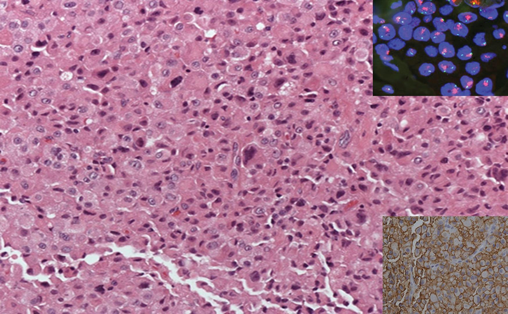 Fig. 20.5, IDC, Nottingham grade 3 (HER2+). These tumors show no hormonal positivity; however, they show HER2 overexpression by IHC (lower insert) or ERBB2/HER gene amplification by a chromogenic method (insert shows florescence in situ hybridization (FISH), ERBB2/HER signals are marked as red signals compared to chromosome 17, green signals).