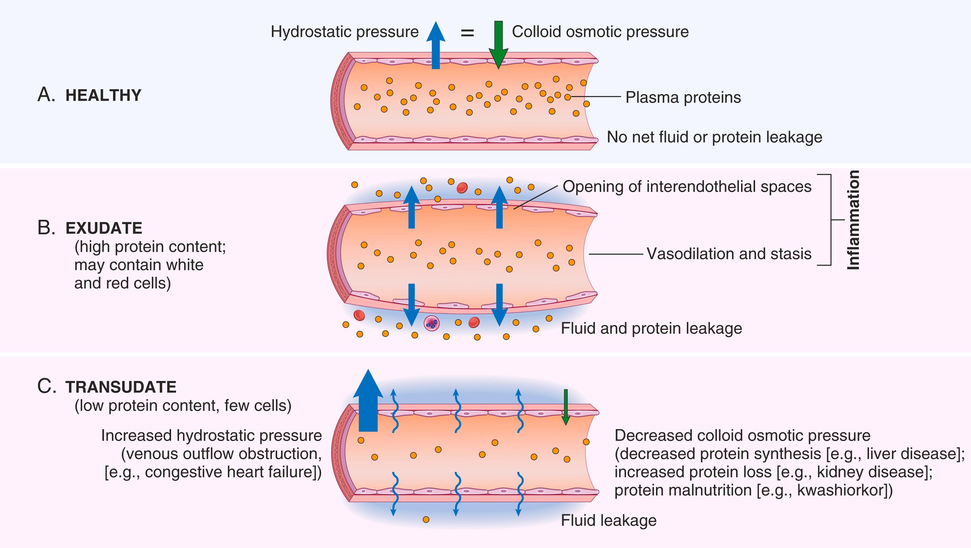 FIG. 2.2, Formation of exudates and transudates. (A) Normal hydrostatic pressure (blue arrow) is about 32 mm Hg at the arterial end of a capillary bed and 12 mm Hg at the venous end; the mean colloid osmotic pressure of tissues is approximately 25 mm Hg (green arrow) . Therefore, there is virtually no net flow of fluid across the vascular bed in the steady state. (B) An exudate is formed in inflammation because vascular permeability increases as a result of retraction of endothelial cells, creating spaces through which fluid and proteins can pass. (C) A transudate is formed when fluid leaks out because of increased hydrostatic pressure or decreased osmotic pressure.