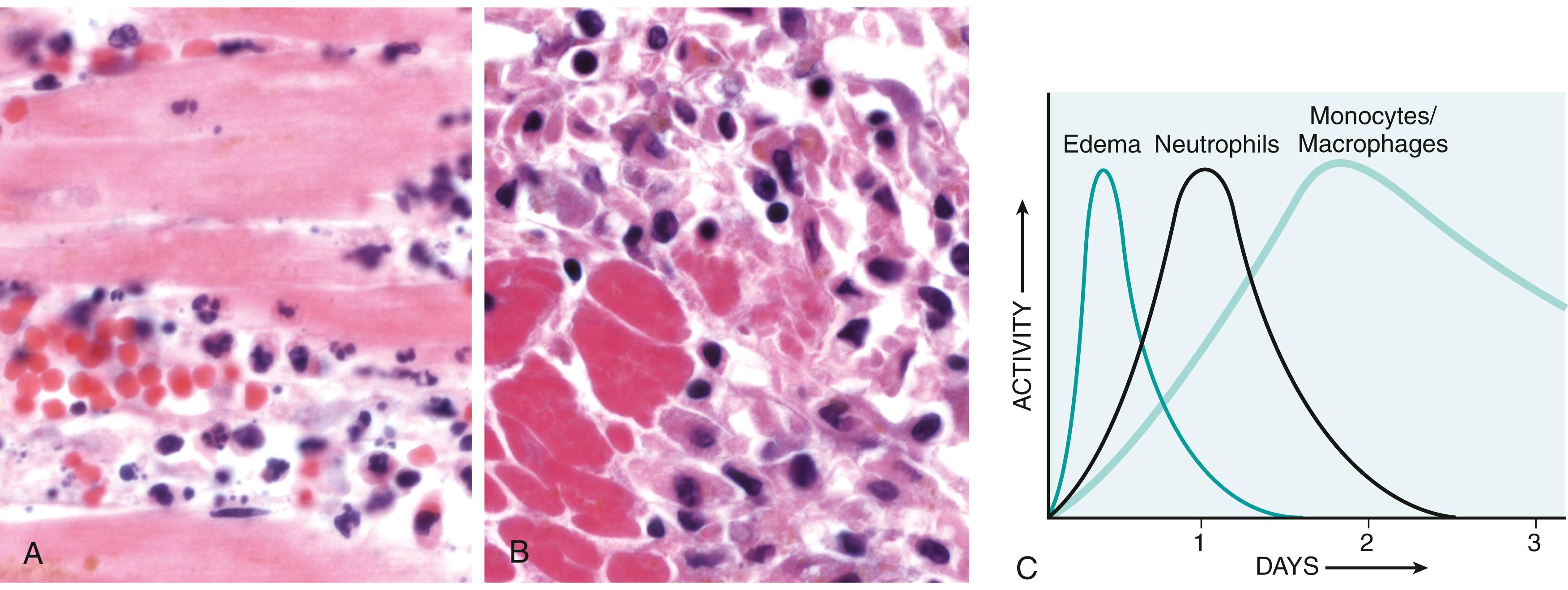 FIG. 2.4, Nature of leukocyte infiltrates in inflammatory reactions. The photomicrographs show an inflammatory reaction in the myocardium after ischemic necrosis (infarction). (A) Early neutrophilic infiltrates and congested blood vessels. (B) Later mononuclear cell infiltrates (mostly macrophages). (C) The approximate kinetics of edema and cellular infiltration. The kinetics and nature of the infiltrate may vary depending on the severity and cause of the reaction.