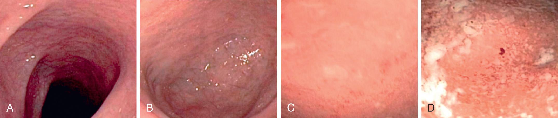 Fig. 362.1, Mayo endoscopic score for ulcerative colitis.