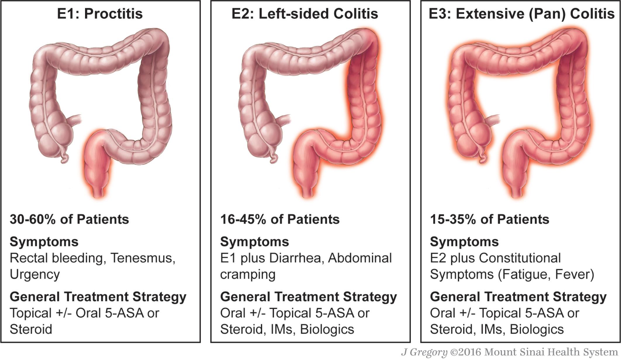 Fig. 362.2, Ulcerative colitis phenotypes by Montreal Classification. Symptoms and treatment strategy can differ based on extent of disease.