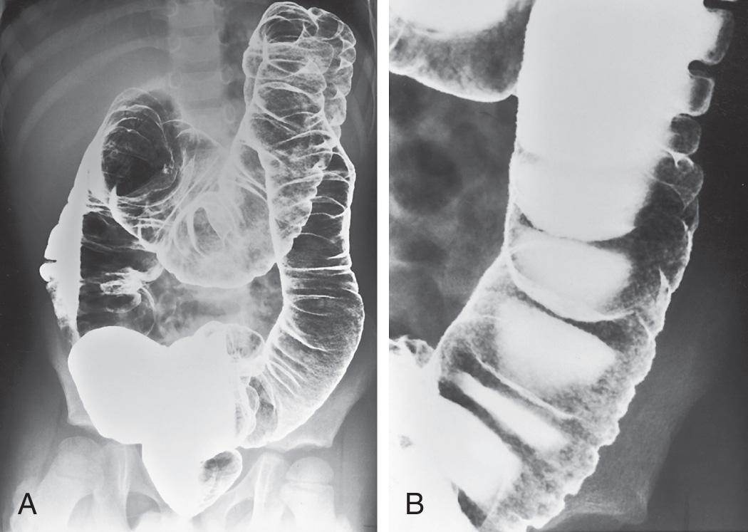 Fig. 362.3, Ulcerative colitis.