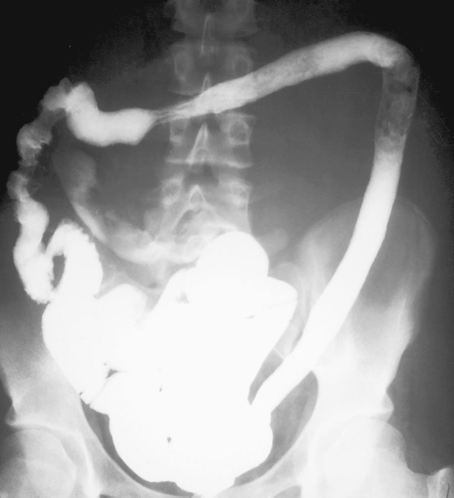 Fig. 362.4, Ulcerative colitis: late changes.